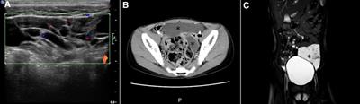 Robotic-assisted laparoscopic management of mesenteric cysts in children